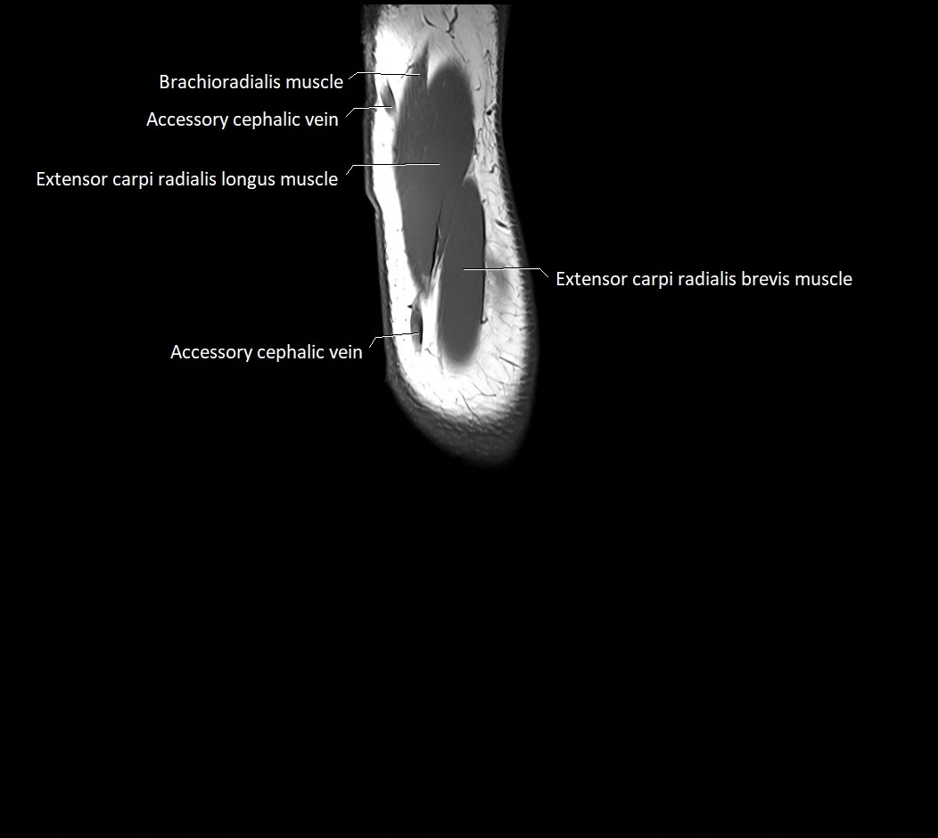 MRI 3T forearm sagittal labelled cross sectional anatomy image 4.webp